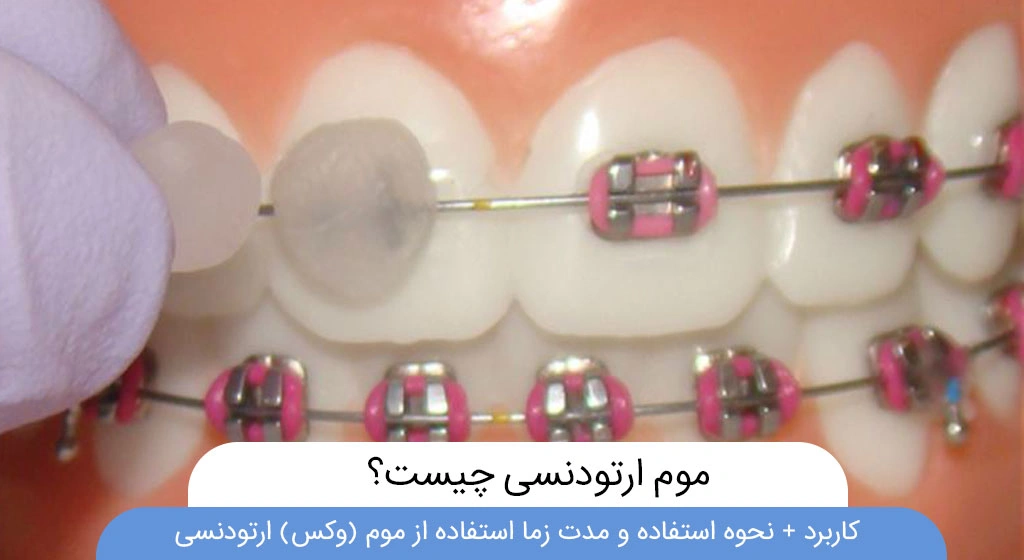 موم ارتودنسی چیست