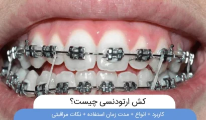 کش ارتودنسی چیست؟
