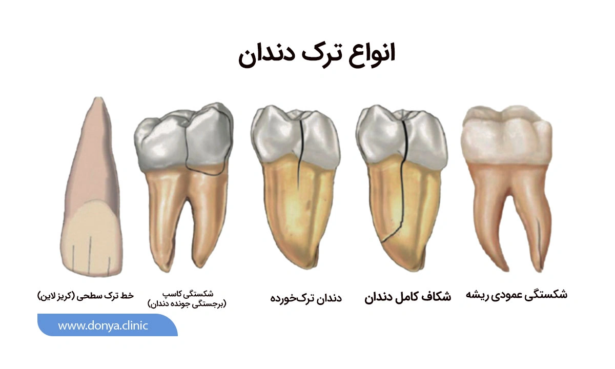 انواع ترک دندان