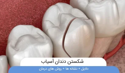 شکستن دندان آسیاب