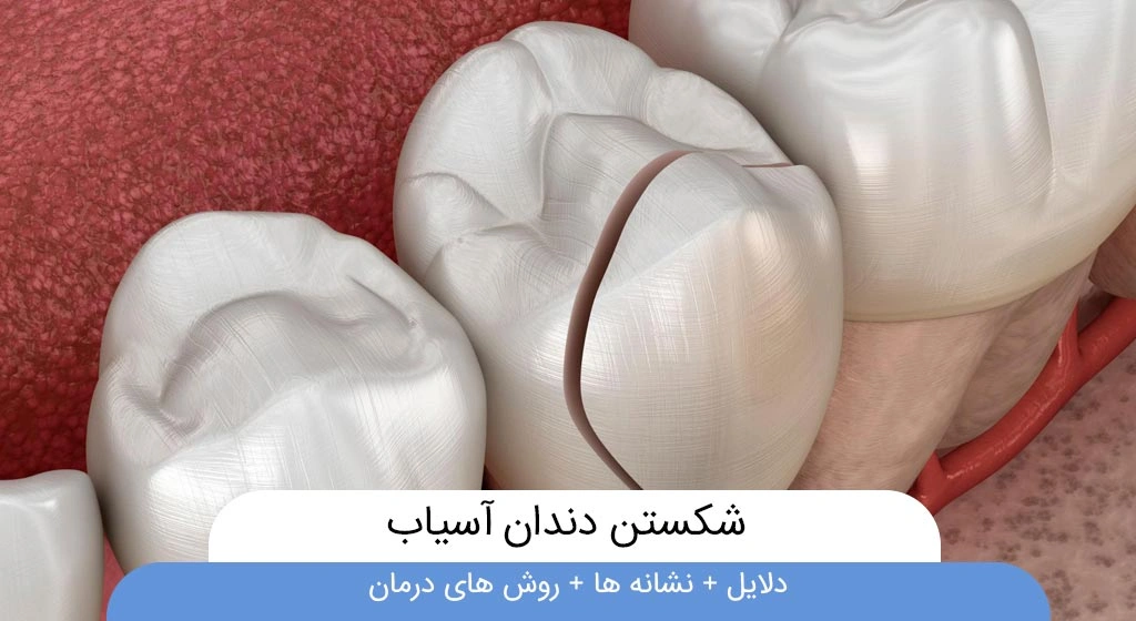 شکستن دندان آسیاب