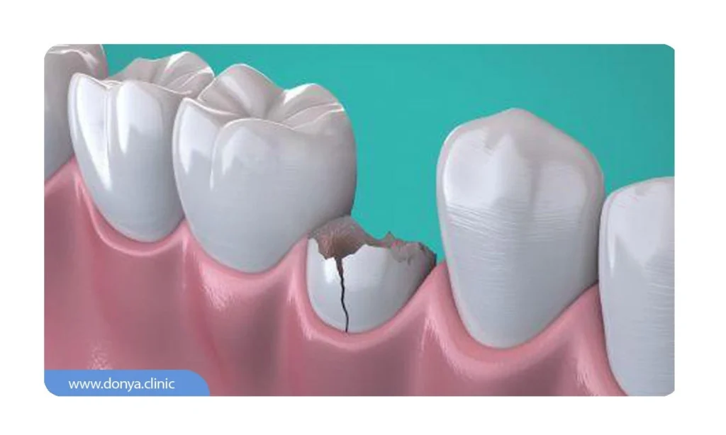شکستگی کامل دندان آسیاب