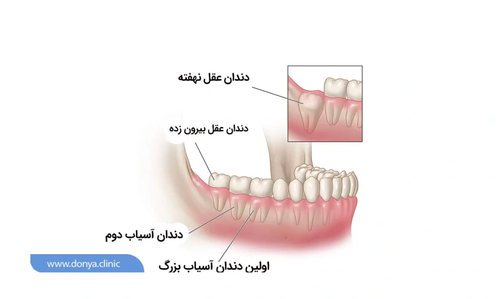 جایگاه دندان عقل در فک