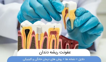 عفونت ریشه دندان