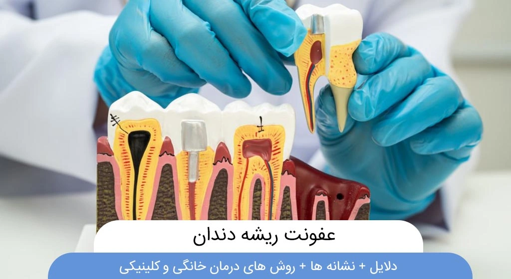 عفونت ریشه دندان