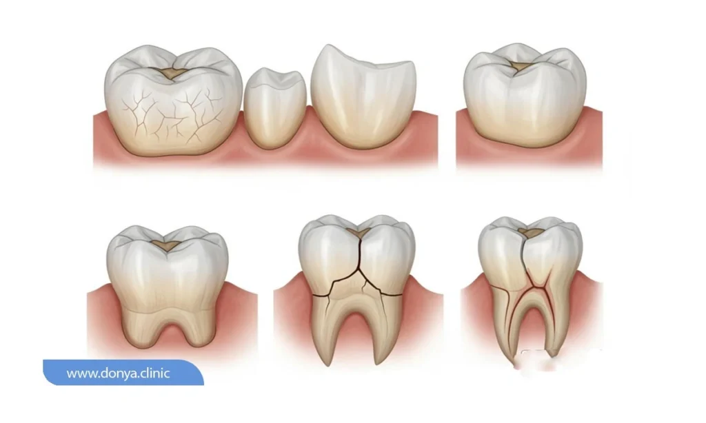 انواع شکستگی دندان آسیاب