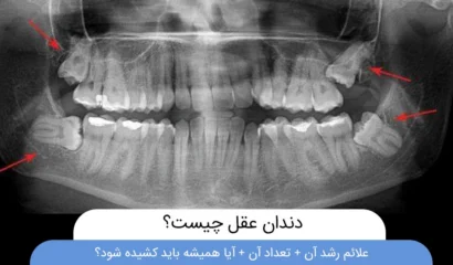 دندان عقل چیست؟