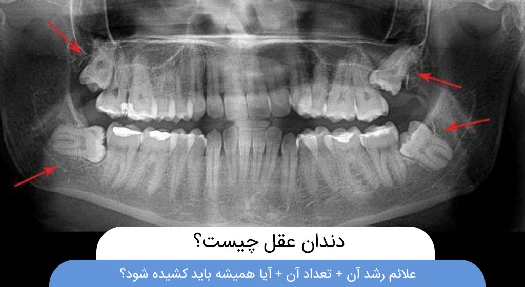 دندان عقل چیست؟