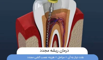 درمان ریشه مجدد