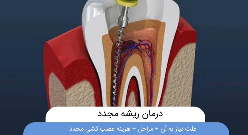 درمان ریشه مجدد