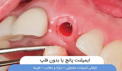 ایمپلنت پانچ یا بدون فلپ
