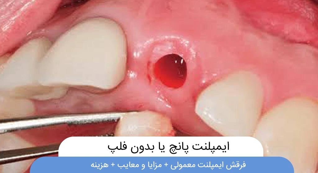 ایمپلنت پانچ یا بدون فلپ