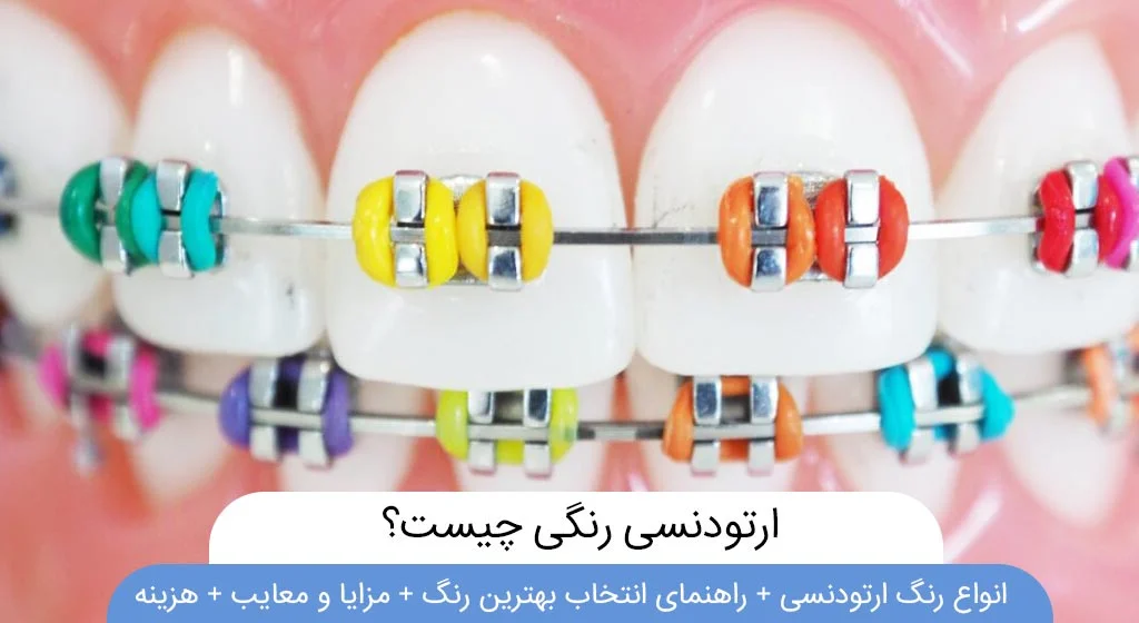 ارتودنسی رنگی چیست؟