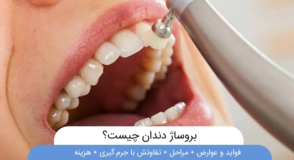 بروساژ دندان چیست؟