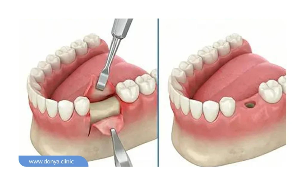 فرق ایمپلنت پانچ با معمولی چیست؟